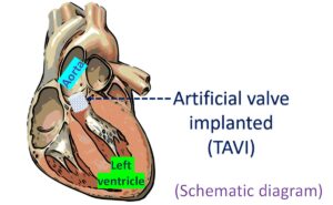 What Is Tavi? Cardiology Basics – All About Cardiovascular System And 