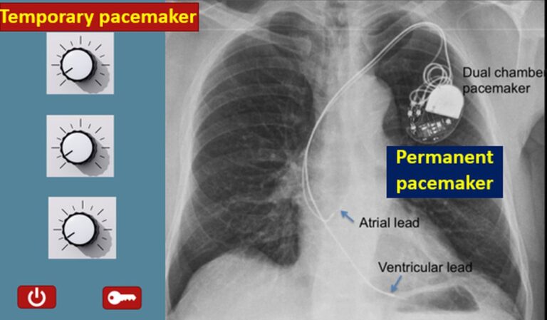 What Is A Pacemaker All About Heart And Blood Vessels   Temporary And Permanent Pacemakers 768x449 