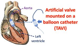 What is TAVI? Cardiology Basics – All About Cardiovascular System and ...