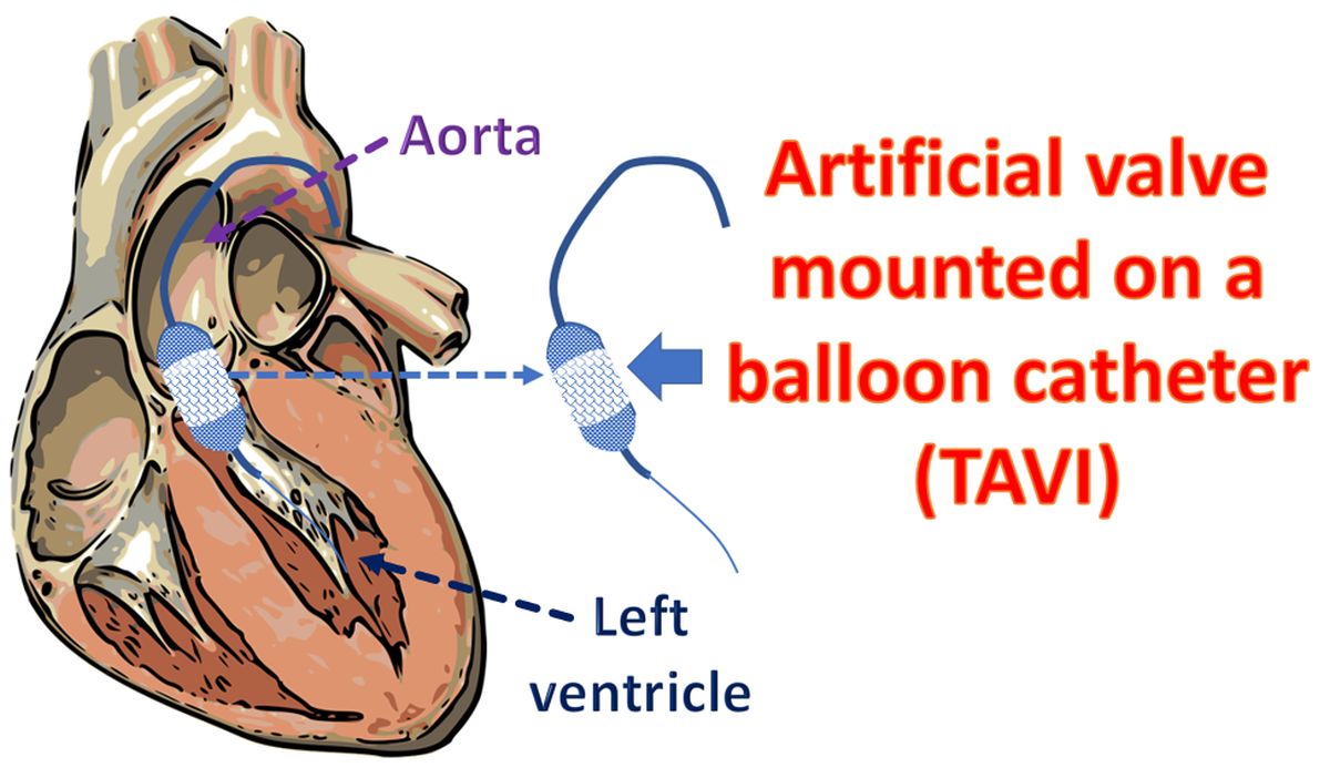 Transcatheter aortic valve implantation (TAVI)