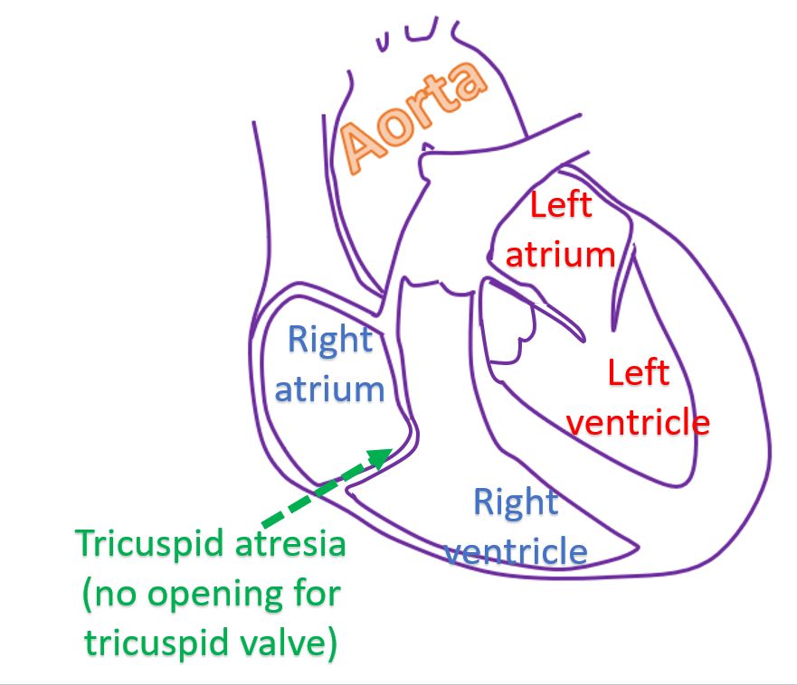 Tricuspid atresia (no opening for tricuspid valve)