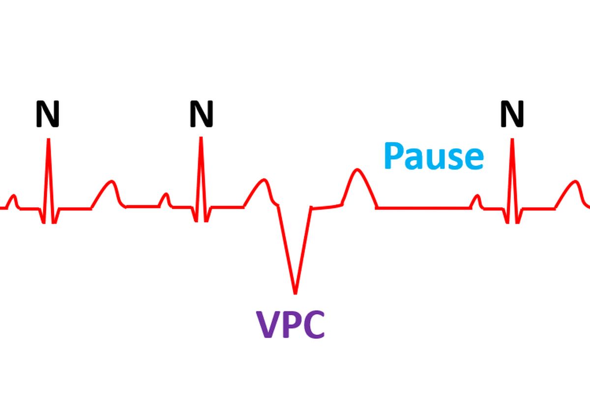 Ventricular premature complex (VPC)