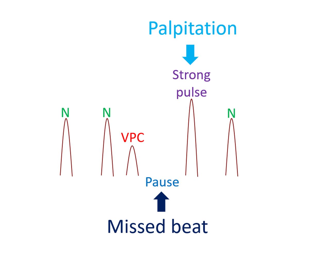 Weak pulse, missed beat and palpitation in ventricular premature complex