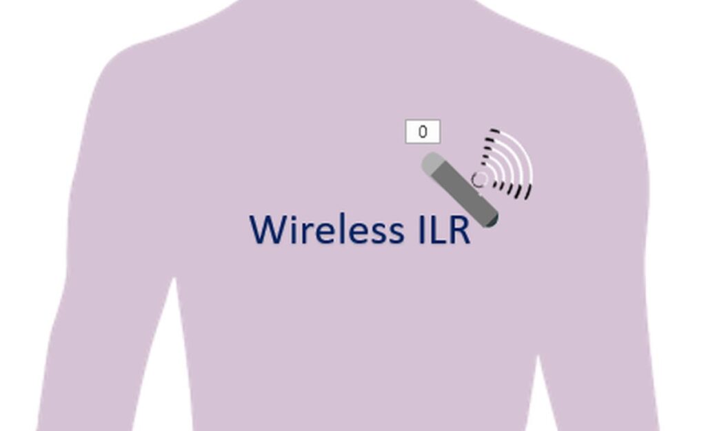 Wireless implantable loop recorders