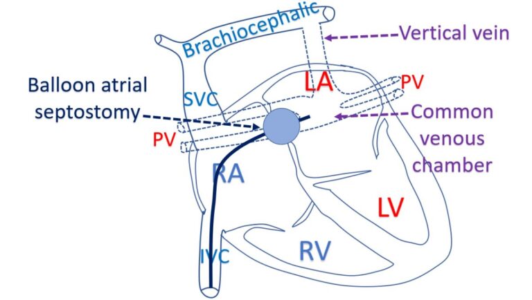 What is TAPVC? – All About Heart And Blood Vessels