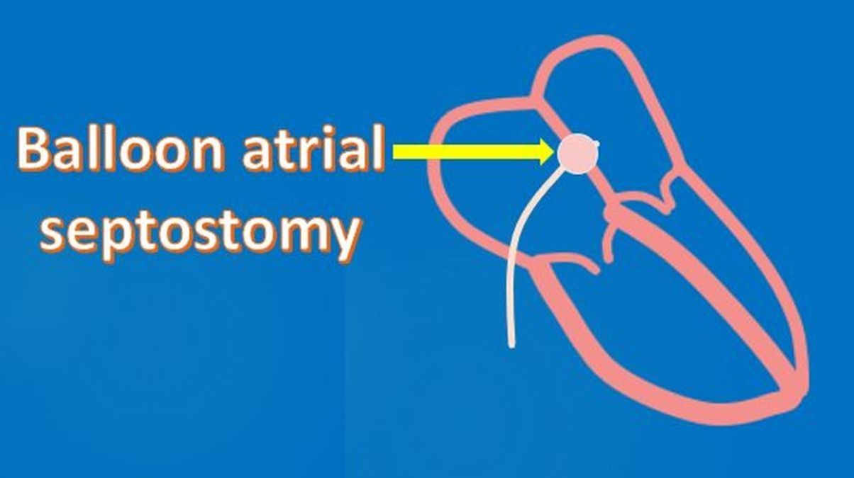 Balloon atrial septostomy