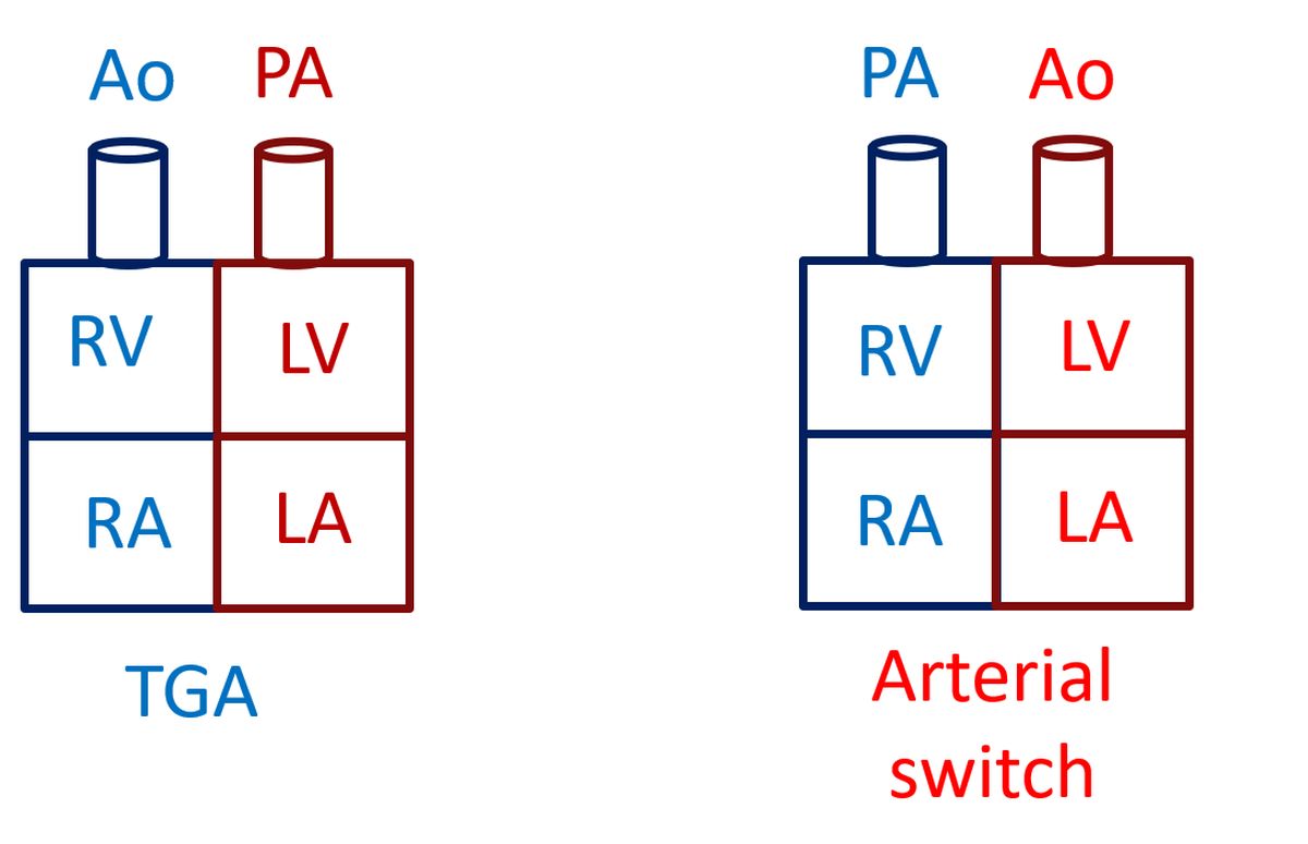 Block diagram illustrating arterial switch operation in TGA