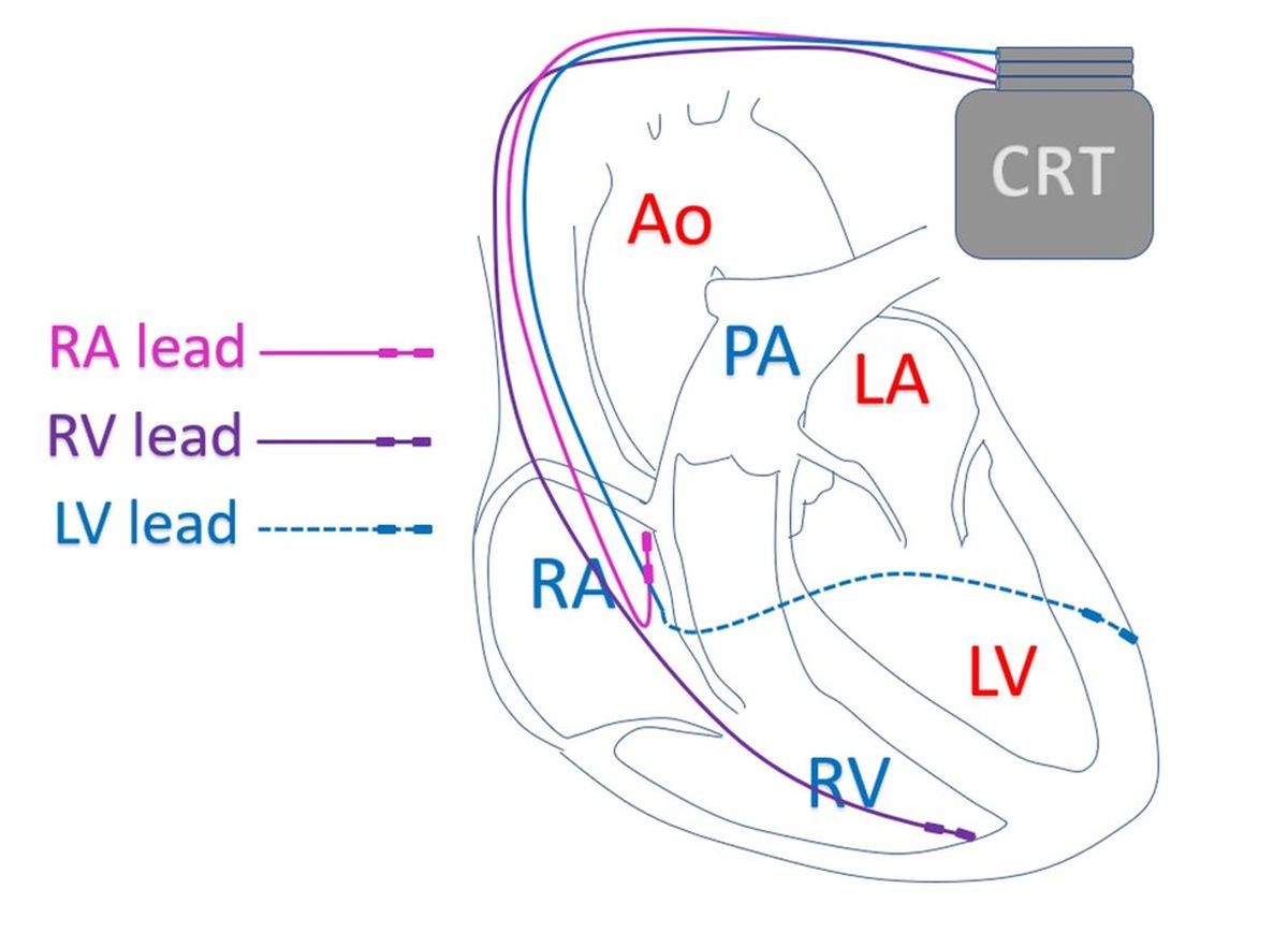 CRT-P with leads (Schematic diagram)
