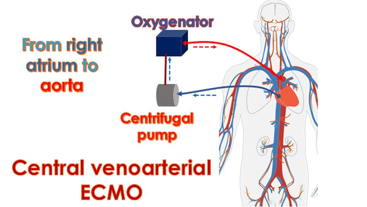 Central venoarterial ECMO