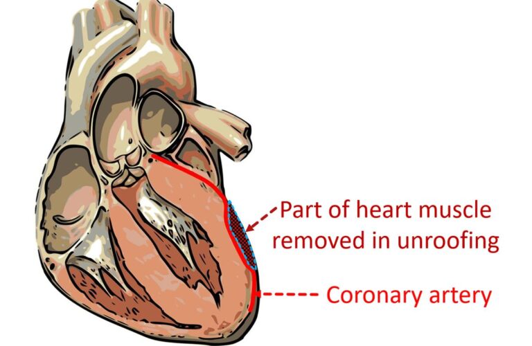 What is unroofing of a myocardial bridge? – All About Heart And Blood ...