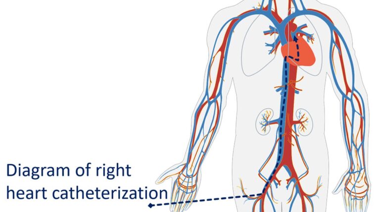 What is cath test? - All About Heart And Blood Vessels