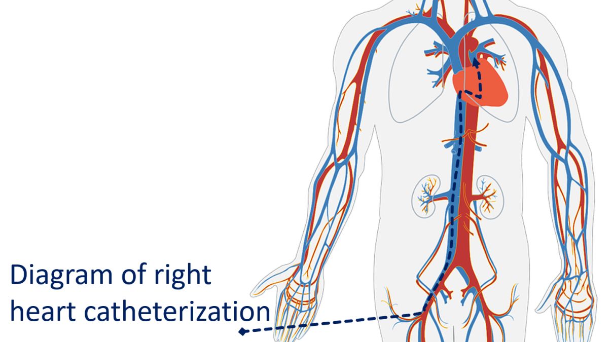 Diagram of right heart catheterization