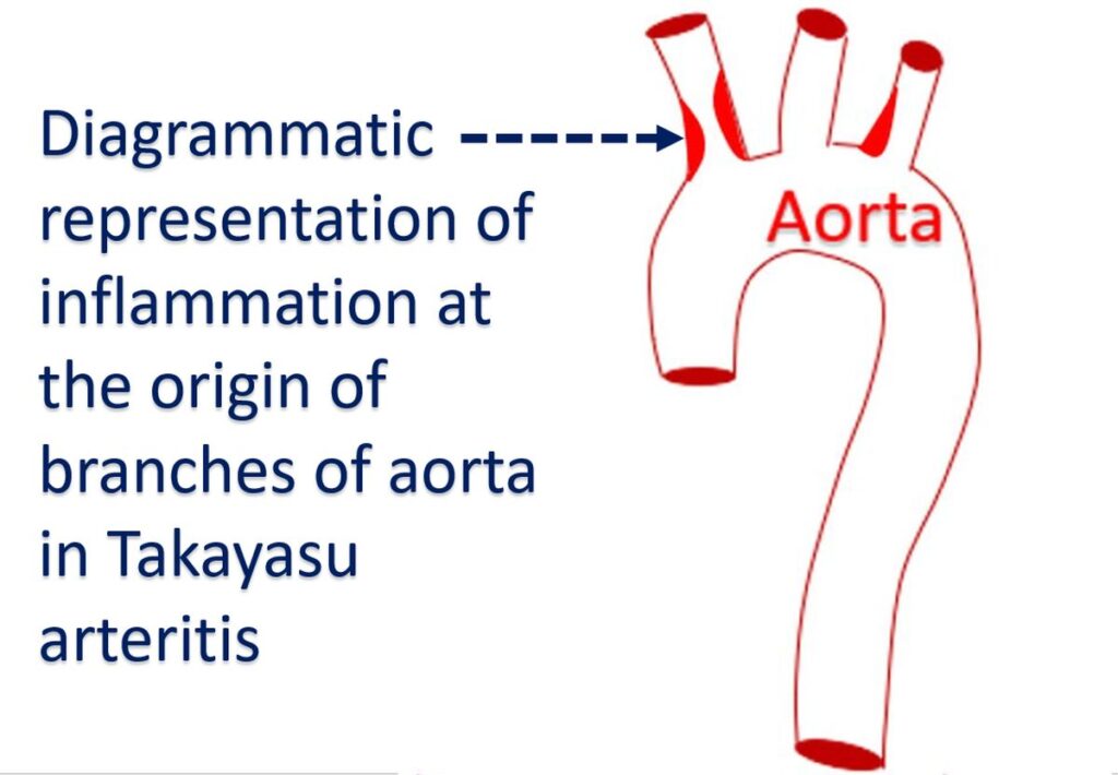 Diagrammatic representation of inflammation at the origin of branches of aorta in Takayasu arteritis
