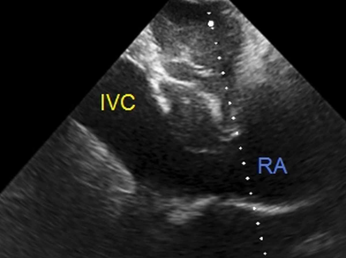 Dilated IVC seen on echocardiogram