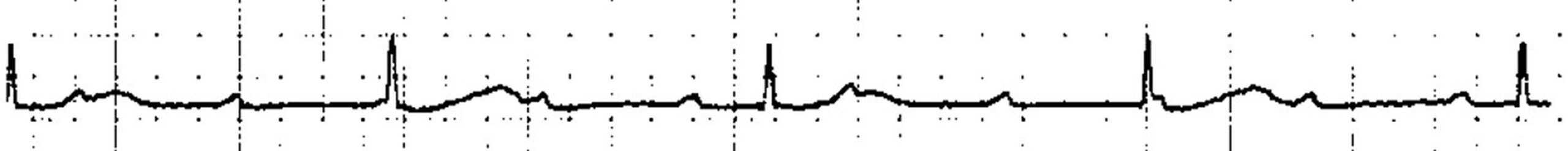 ECG showing complete heart block