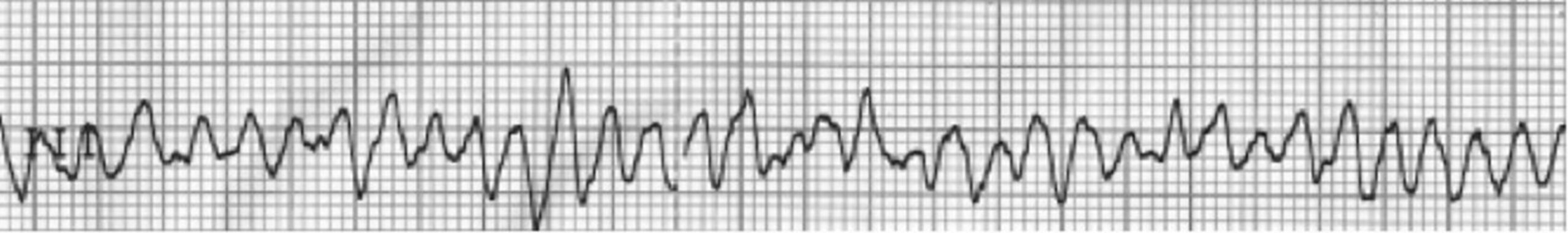 ECG showing ventricular fibrillation, the most dangerous heart rhythm abnormality