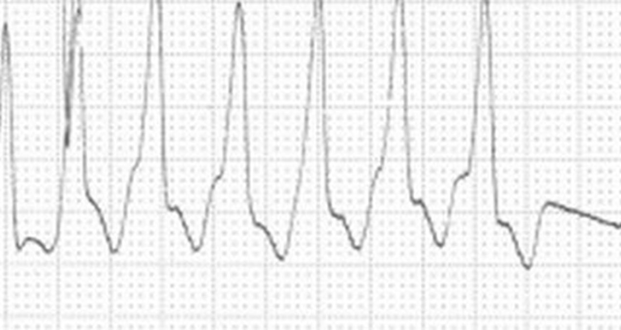 ECG showing ventricular tachycardia