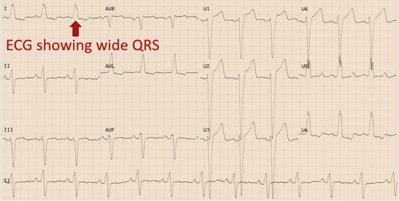 ECG showing wide QRS complex and LBBB pattern