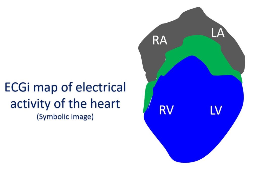 ECGi map of electrical activity of the heart (Symbolic image)