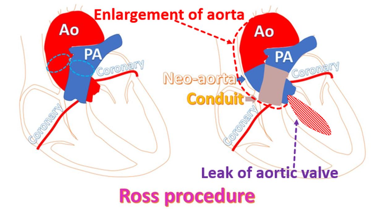 Enlargement of aorta and leak of aortic valve after Ross procedure