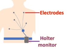 Holter monitor diagram