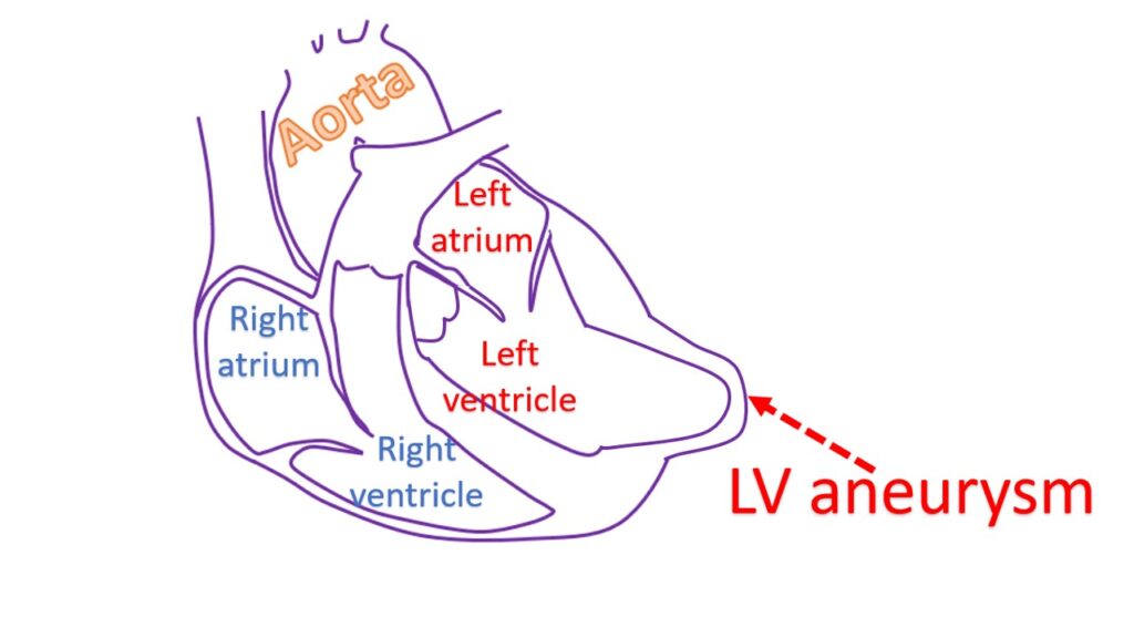 What is left ventricular aneurysm? – All About Heart And Blood Vessels