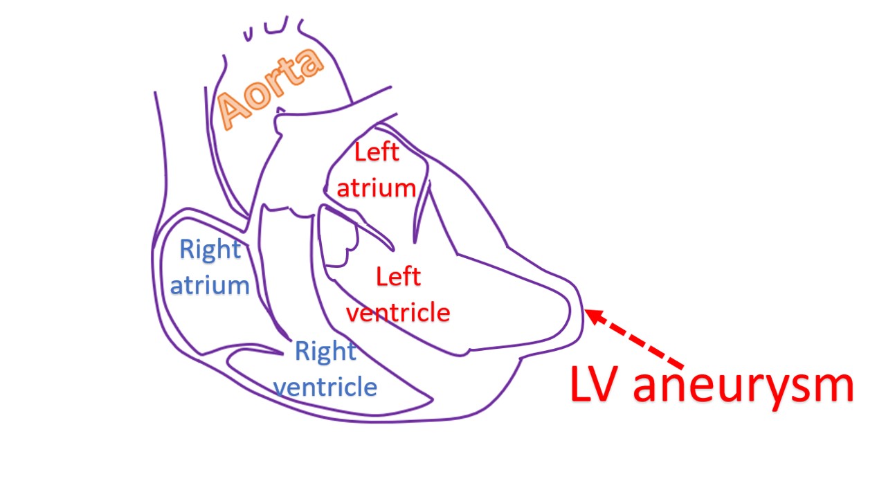 LV aneurysm