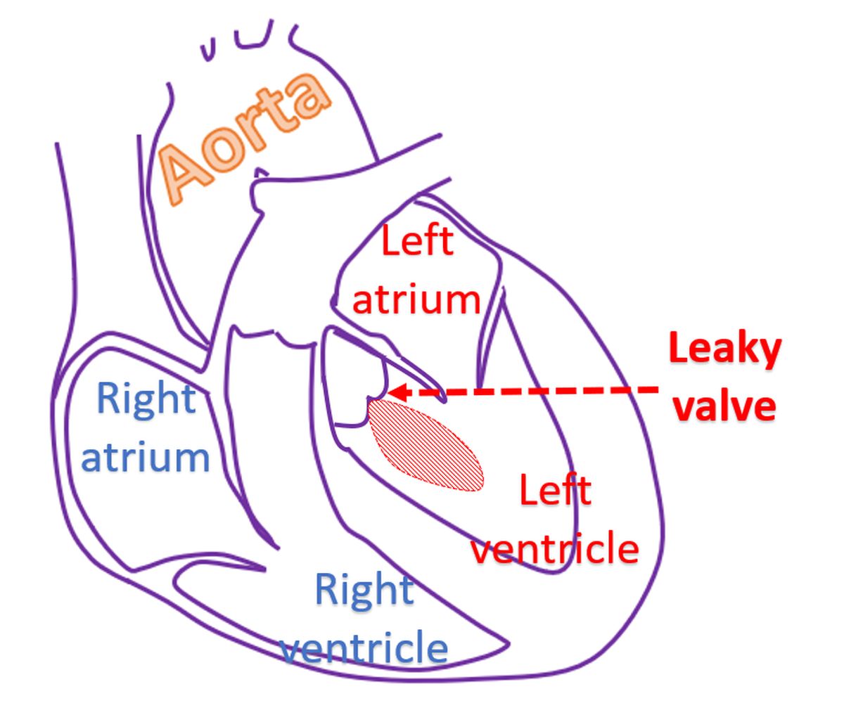 Leaky aortic valve