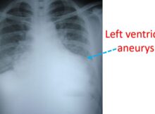Left ventricular aneurysm seen on chest X-ray