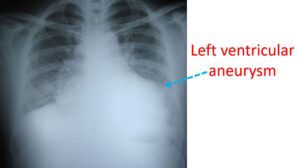 What is left ventricular aneurysm? – All About Heart And Blood Vessels