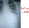 Left ventricular aneurysm seen on chest X-ray