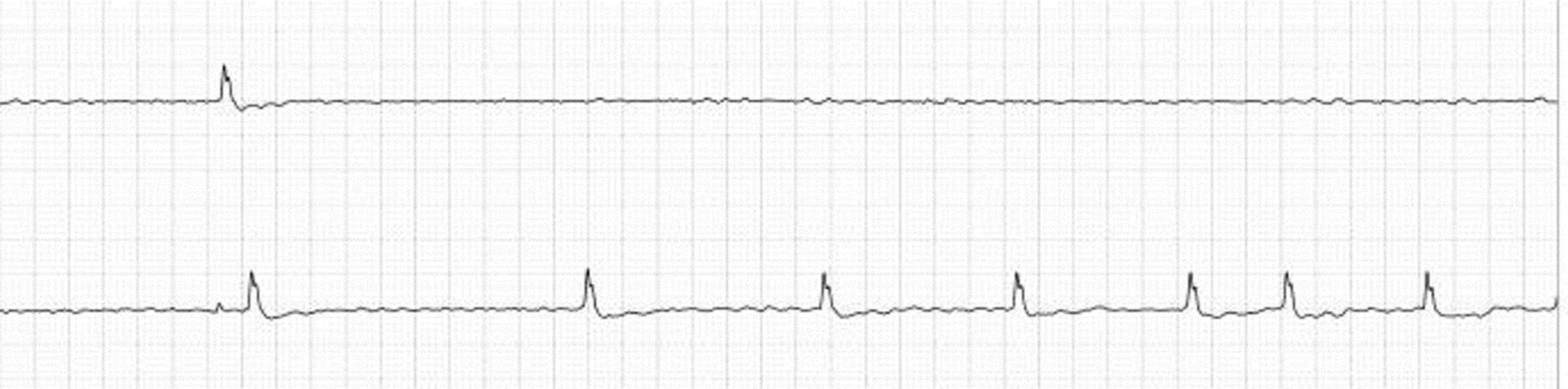 Long pause on ECG due to sick sinus syndrome