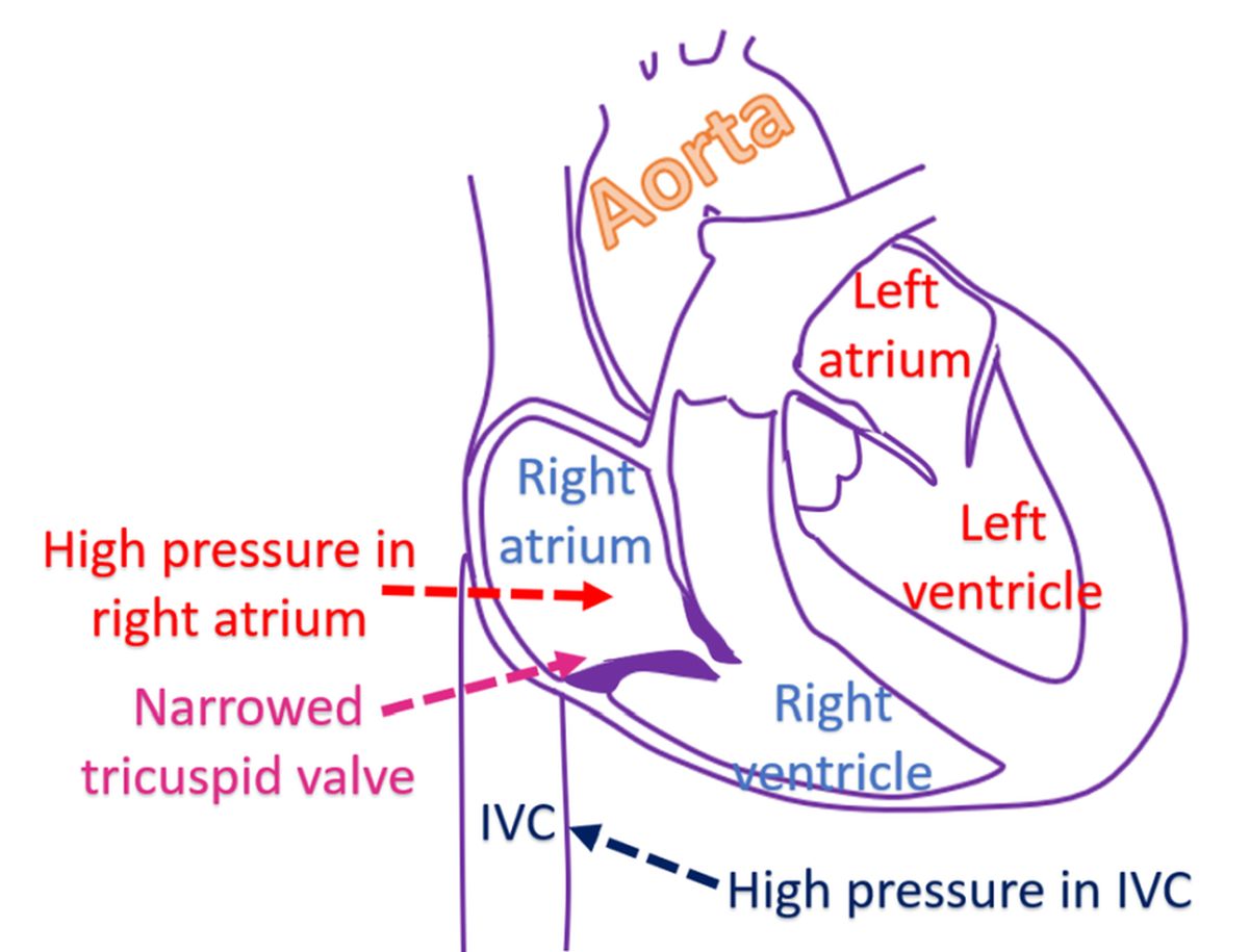 Narrowed tricuspid valve with high pressure in right atrium and IVC