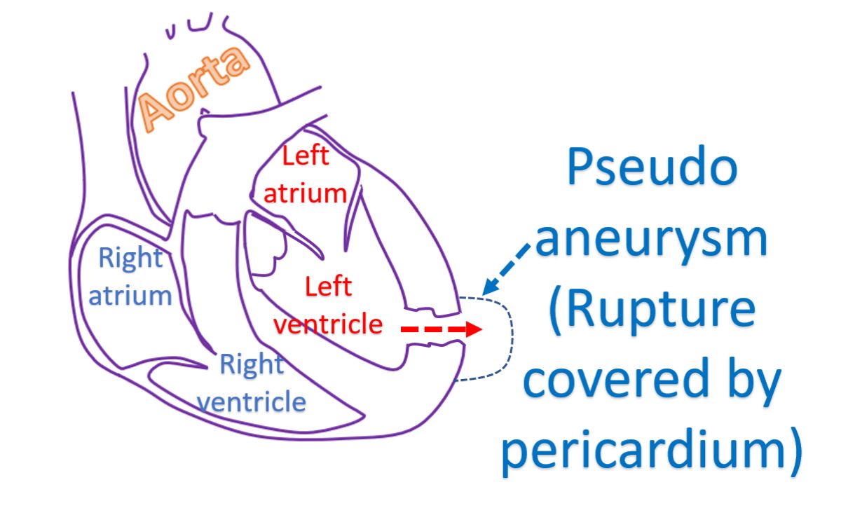 Pseudoaneurysm (Rupture covered by pericardium)