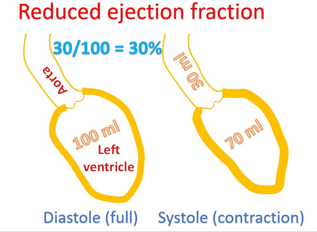 Reduced ejection fraction