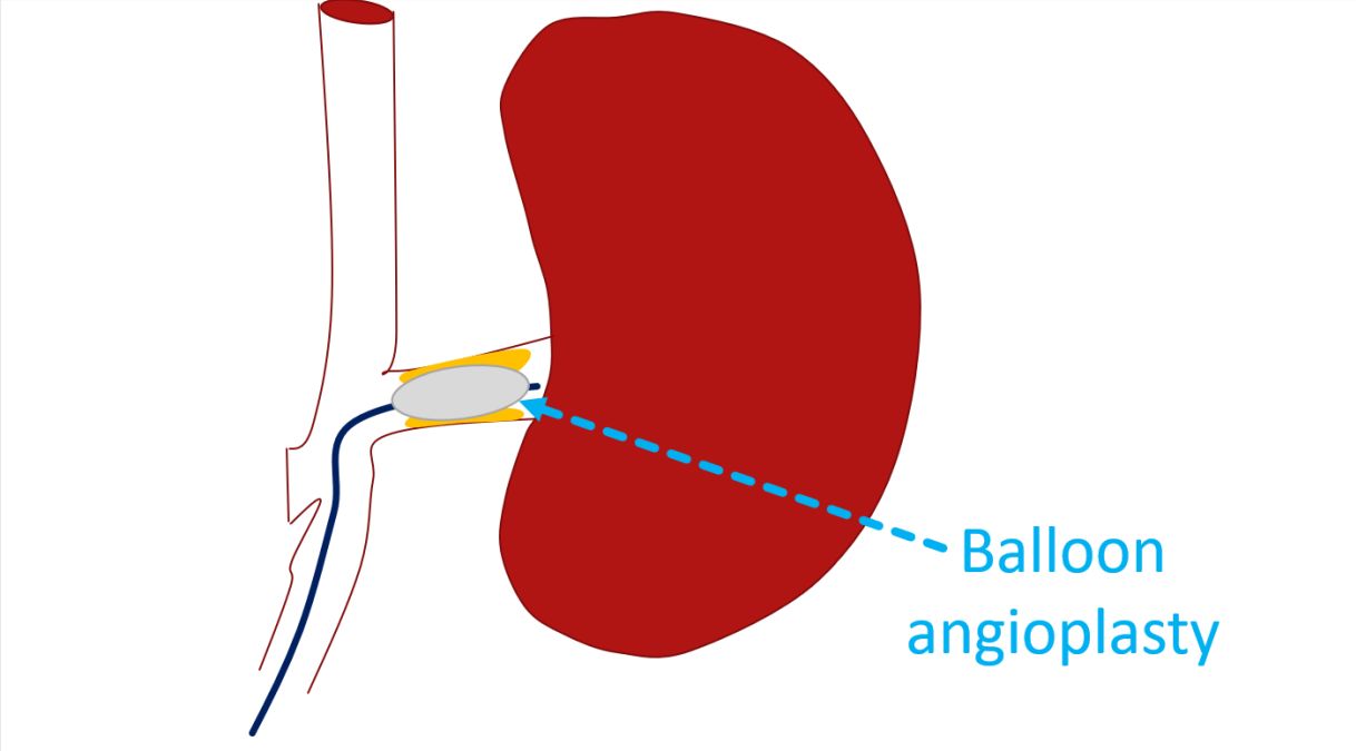 Renal angioplasty