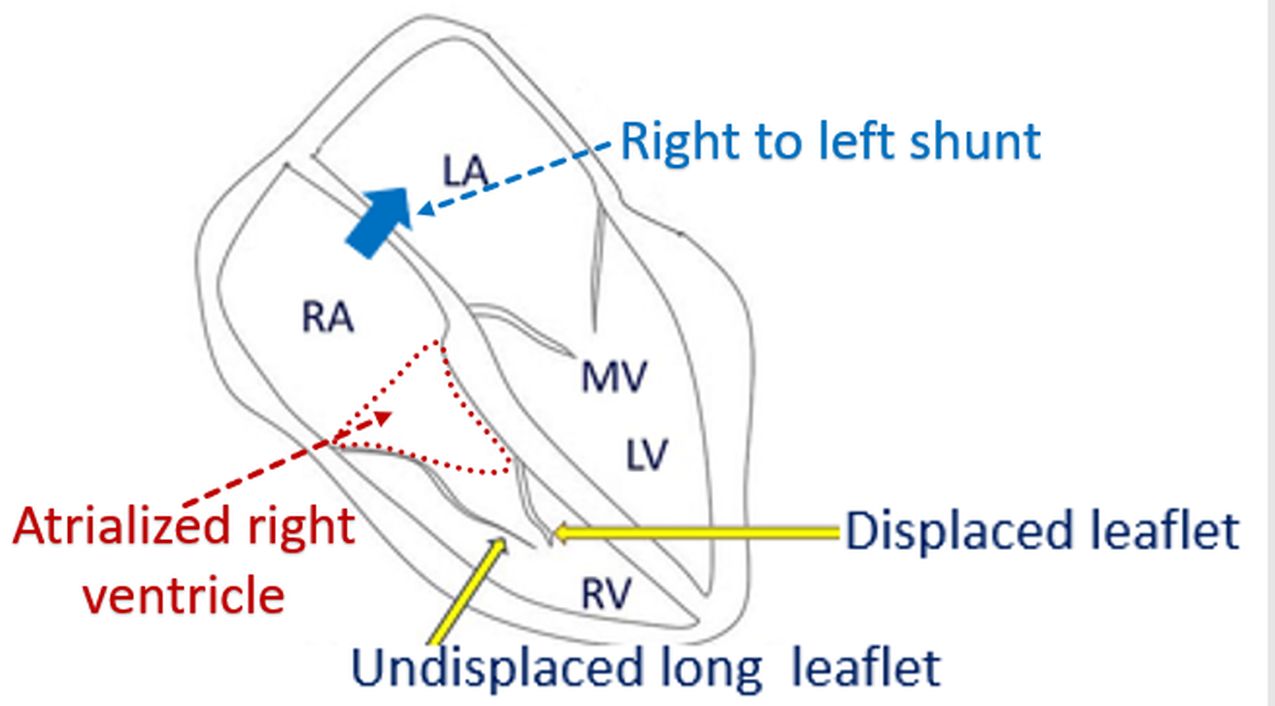 Right to left shunt and atrialized right ventricle in Ebstein's anomaly