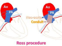 Ross procedure