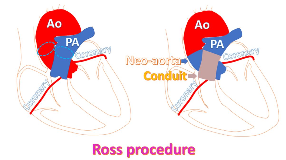 what-is-ross-procedure-all-about-heart-and-blood-vessels