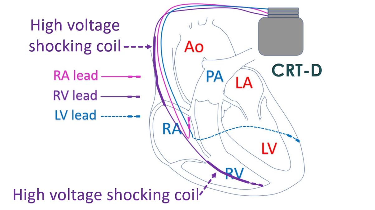 Schematic diagram of CRT-P with pacing leads and high voltage shocking coils