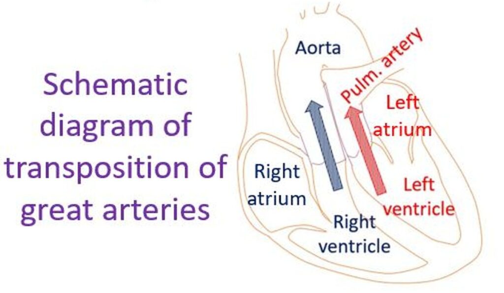What are atrial switch operations? - All About Heart And Blood Vessels