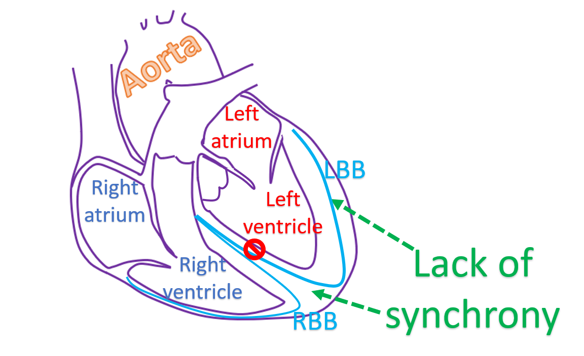 Schematic representation of lack of synchrony in left bundle branch block
