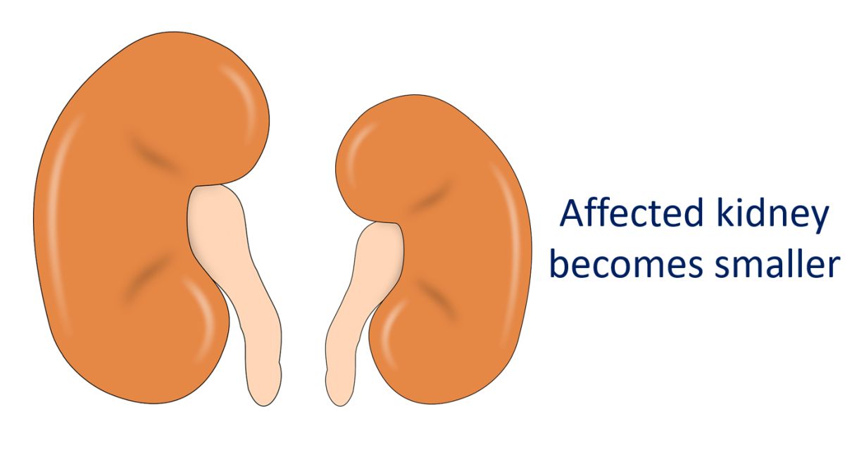 Smaller kidney in renal artery stenosis