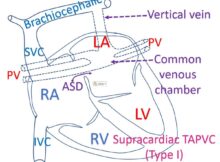 Supracardiac TAPVC (Type I)