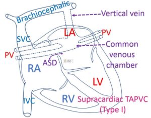 What is TAPVC? – All About Heart And Blood Vessels