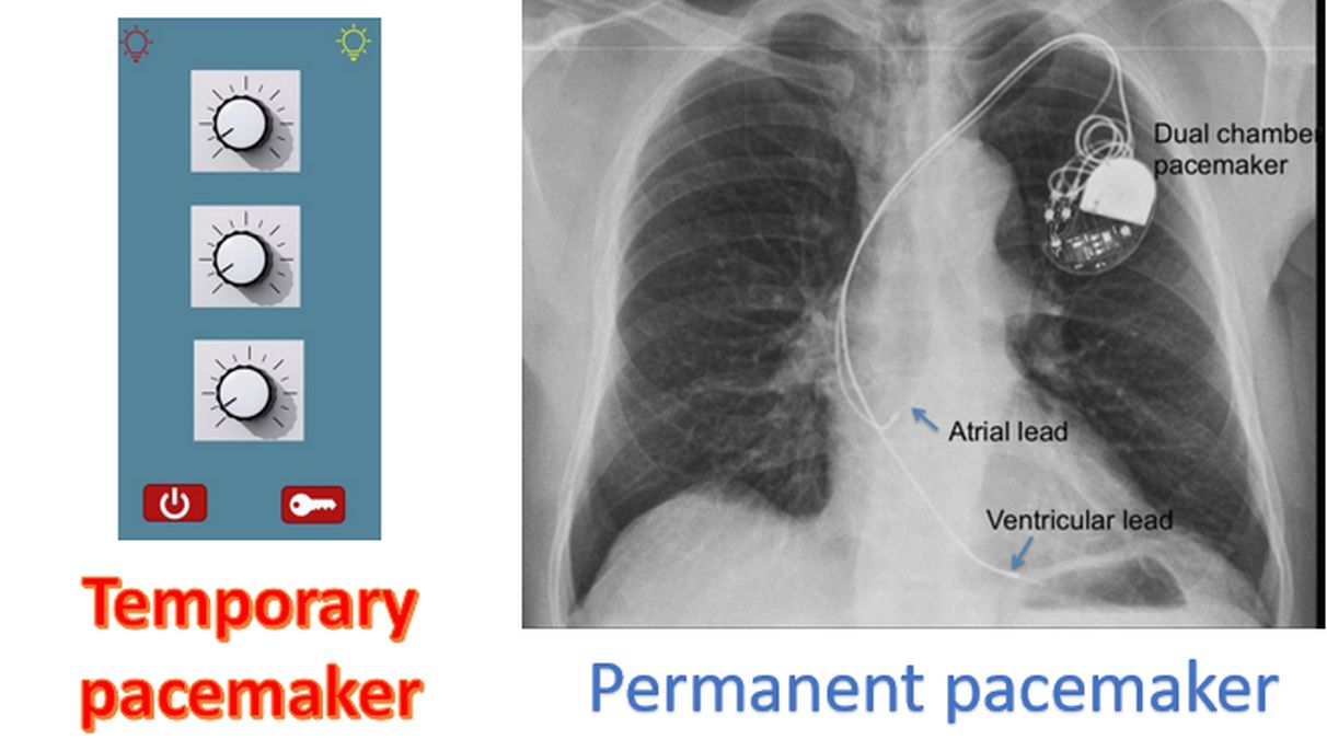 Temporary and permanent pacemakers