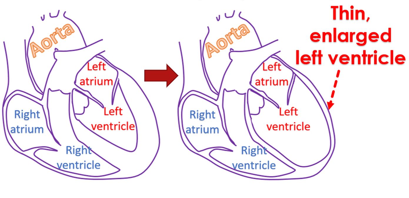 Thin, enlarged left ventricle in peripartum cardiomyopathy