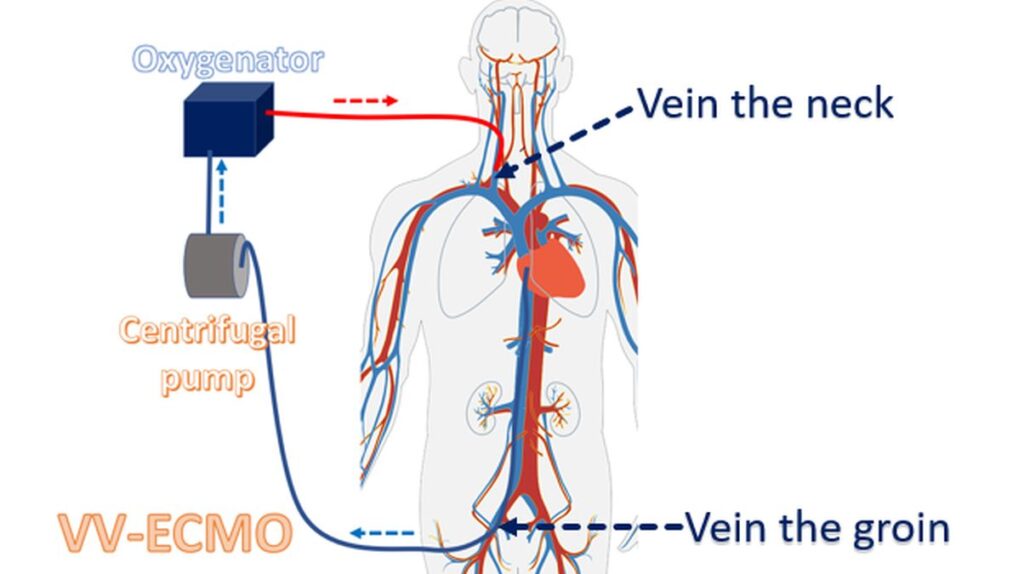 What is ECMO? – All About Heart And Blood Vessels