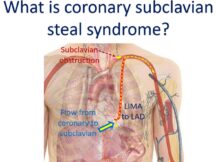 What is coronary subclavian steal syndrome