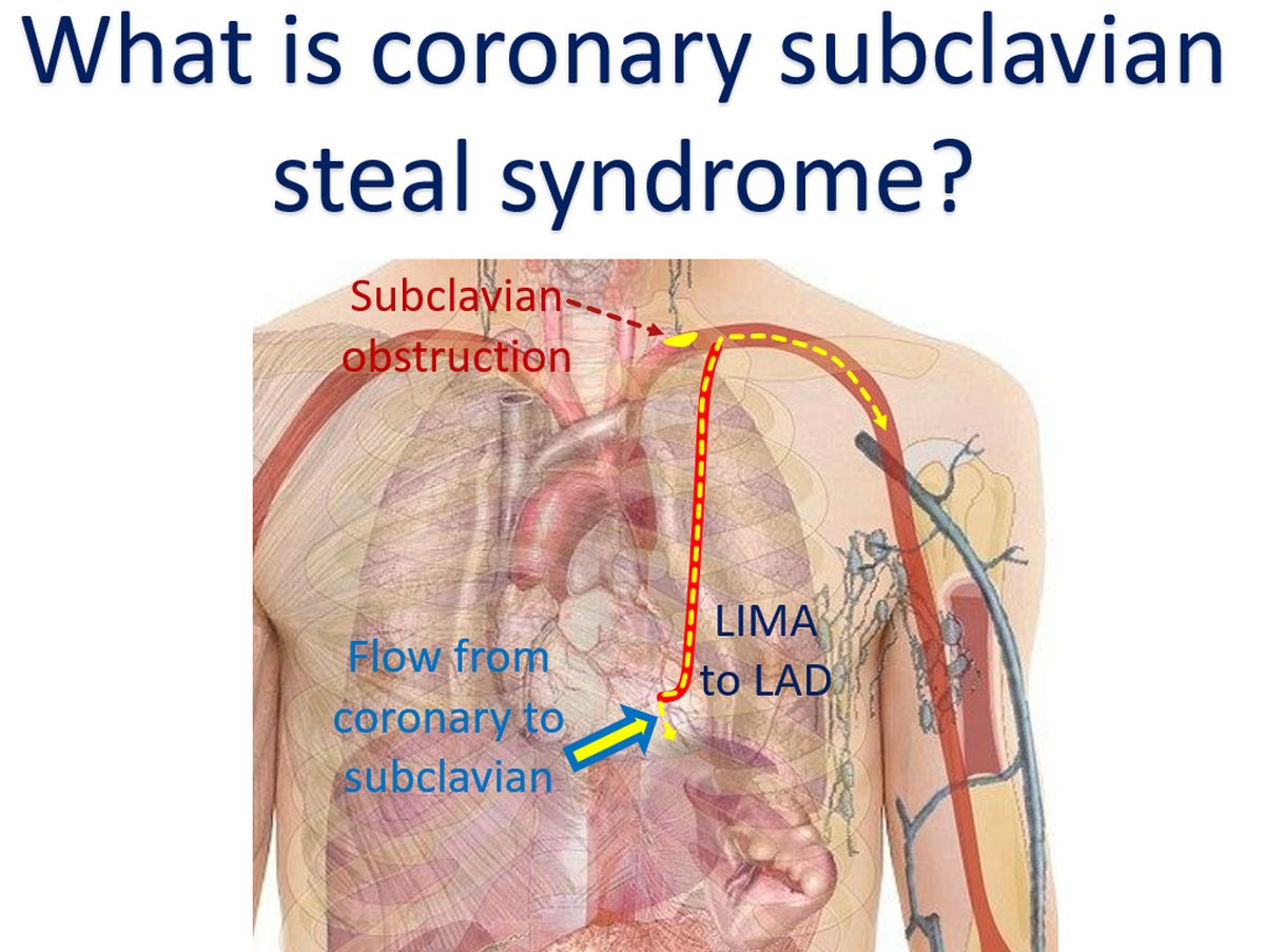 What is coronary subclavian steal syndrome
